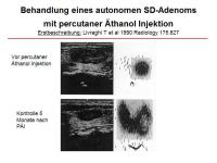 Abbildung 38: Schilddr�senknoten