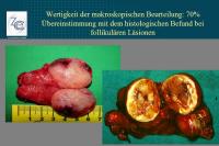 Abbildung 16: Schilddr�senkarzinom