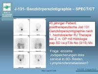 Abbildung 30: Schilddr�senkarzinom
