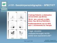 Abbildung 32: Schilddr�senkarzinom
